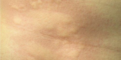 Urticaria Treatment: Medical And Natural Solutions That Help Treat Hives